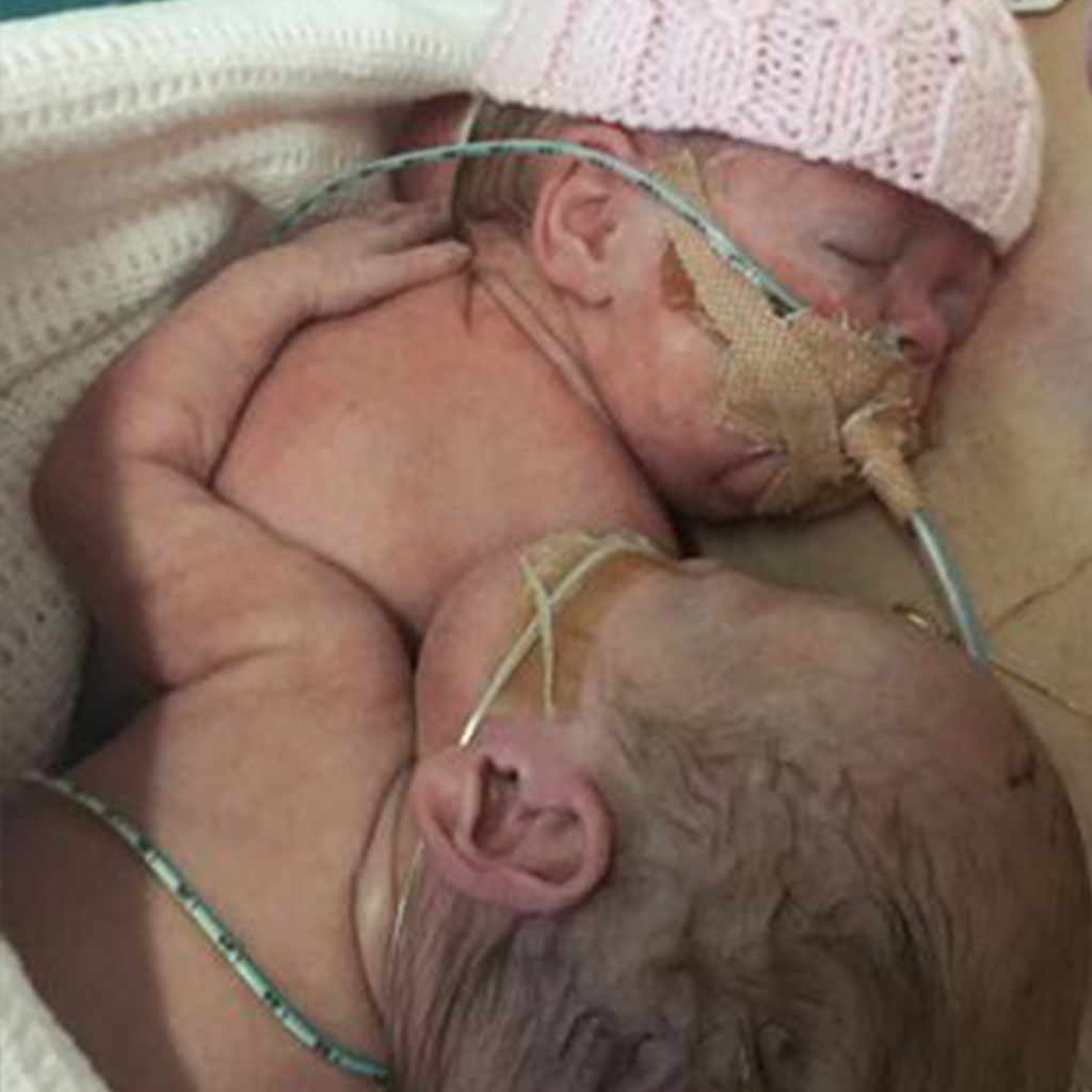Mum Shares Heartbreaking Picture of Premature Baby Cuddling Dying Twin Sister Make You Cry 4