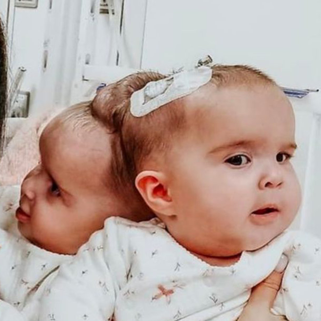 “Against All Odds: The Unbreakable Connection of 9-Month-Old Twins ...